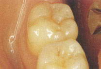жевательные зубы - моляры
